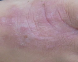 Eczema Treatment